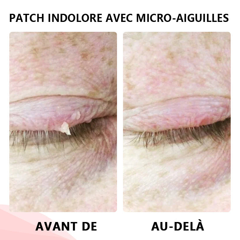 🔥ODALIT™Le patch sans douleur, ultra-efficace🔥