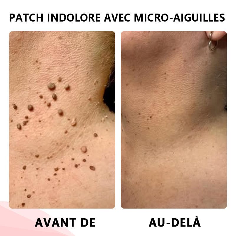 🔥ODALIT™Le patch sans douleur, ultra-efficace🔥